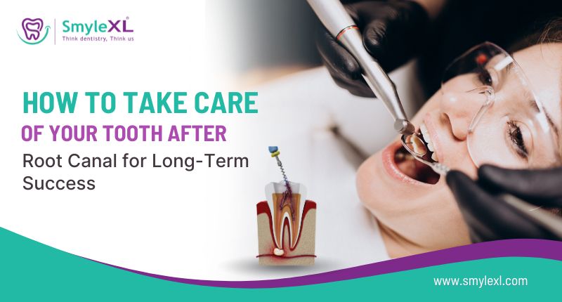 How to Take Care of Your Tooth After a Root Canal for Long-Term Success?