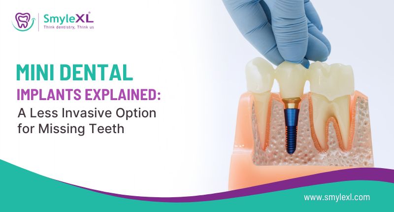 Mini Dental Implants Explained: A Less Invasive Option for Missing Teeth