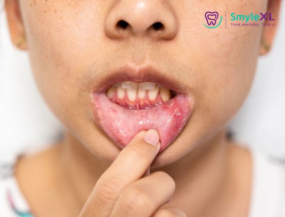 Mouth Ulcers in Kalyan West