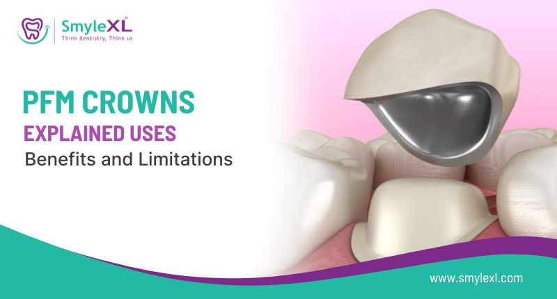 PFM Crowns Explained: Uses, Benefits, and Limitations