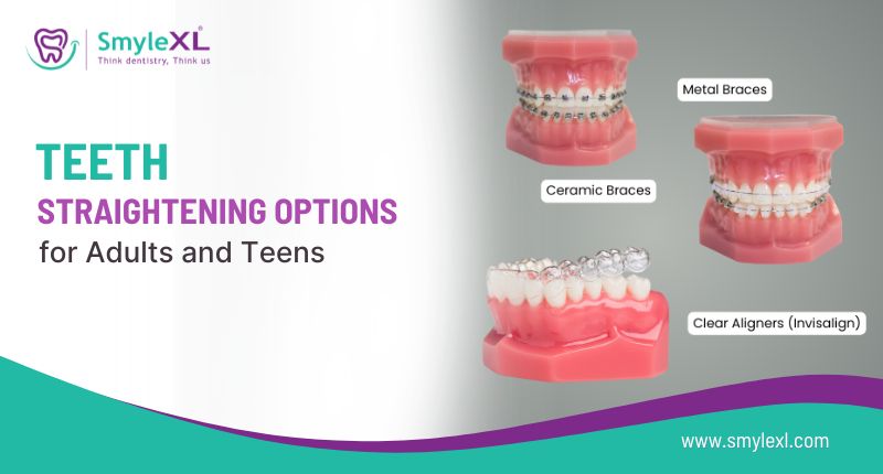Teeth Straightening Options for Adults and Teens