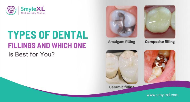 Types of Dental Fillings and Which One Is Best for You