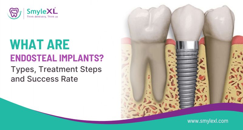 What Are Endosteal Implants? Types, Treatment Steps and Success Rate