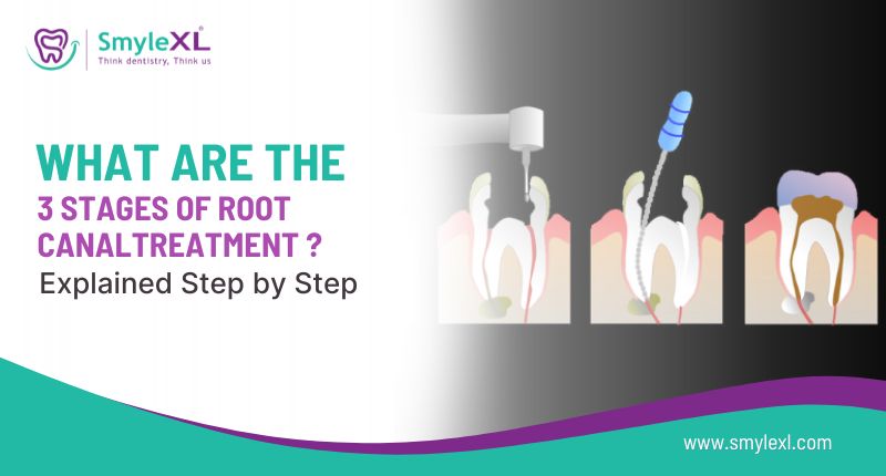 What Are the 3 Stages of Root Canal Treatment?