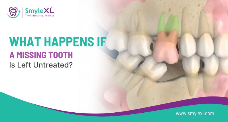 What Happens If a Missing Tooth Is Left Untreated?