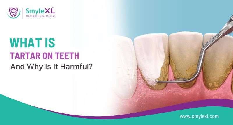 What Is Tartar on Teeth and Why Is It Harmful?