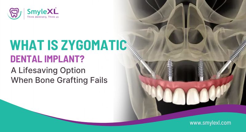 What Is Zygomatic Dental Implant? A Lifesaving Option When Bone Grafting Fails