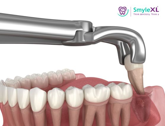 Wisdom Tooth Removal in Kalyan West