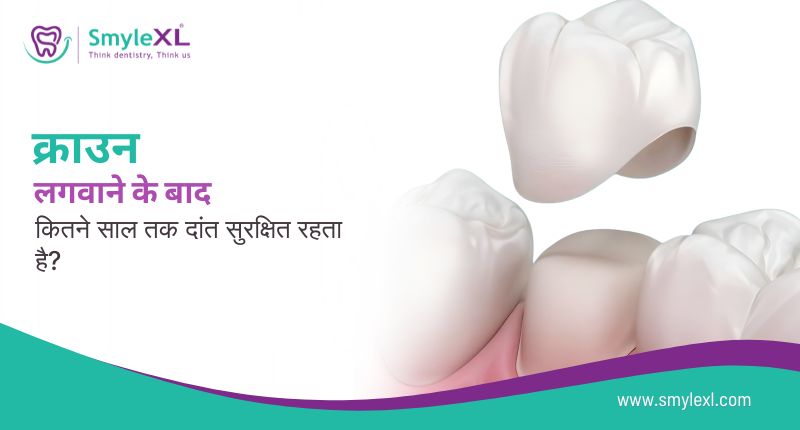 क्राउन लगवाने के बाद कितने साल तक दांत सुरक्षित रहता है?