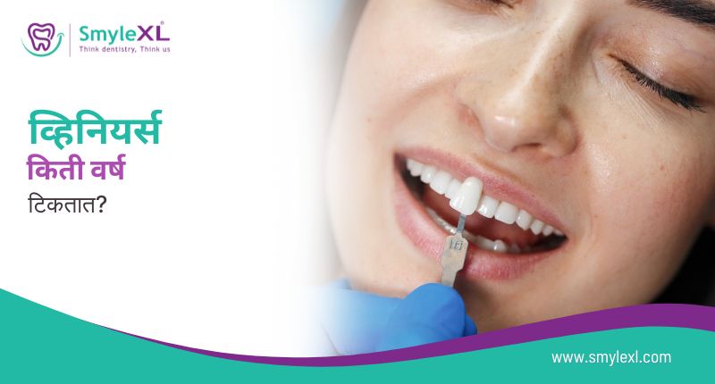 व्हिनियर्स किती वर्ष टिकतात?