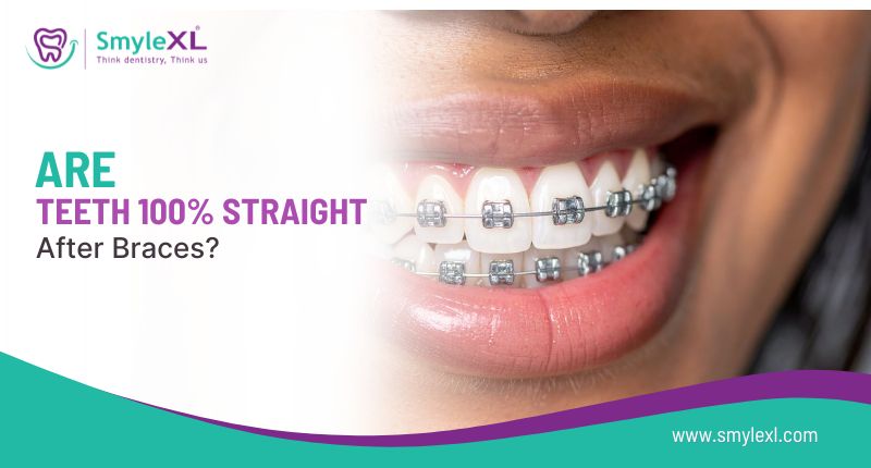 Are Teeth 100% Straight After Braces?
