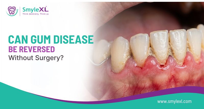 Can Gum Disease Be Reversed Without Surgery?