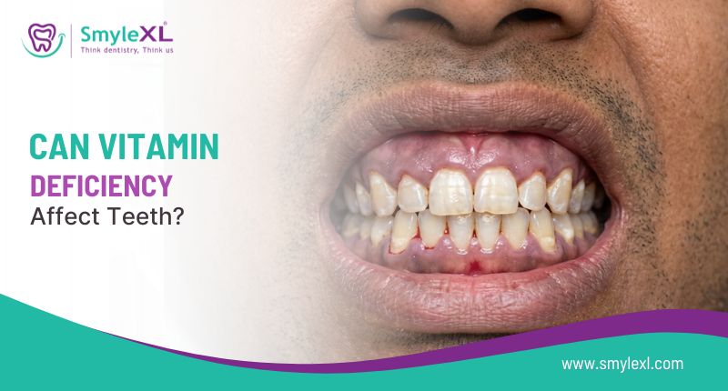 Can Vitamin Deficiency Affect Teeth?