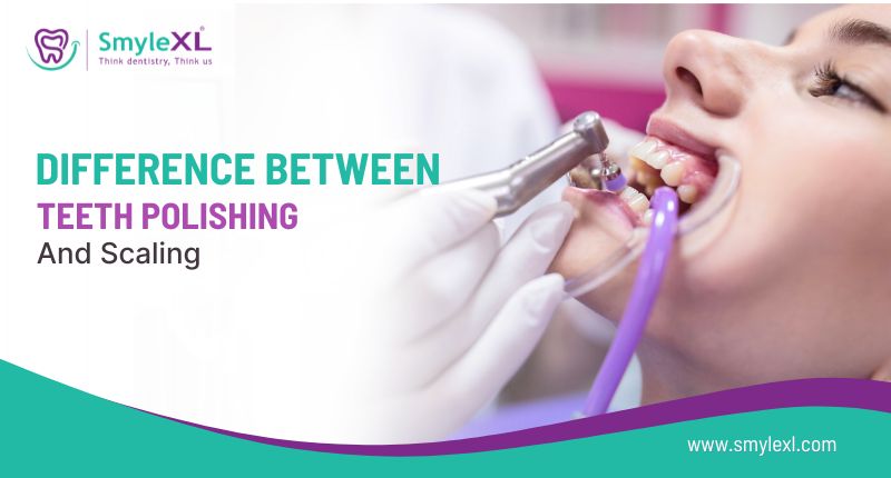 Difference Between Teeth Polishing and Scaling