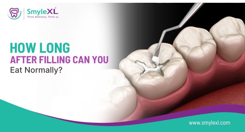 How Long After Filling Can You Eat Normally?