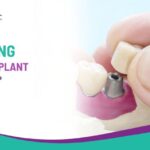 How Long Does an Implant Crown Last?