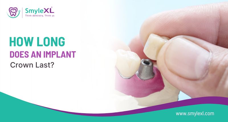 How Long Does an Implant Crown Last?
