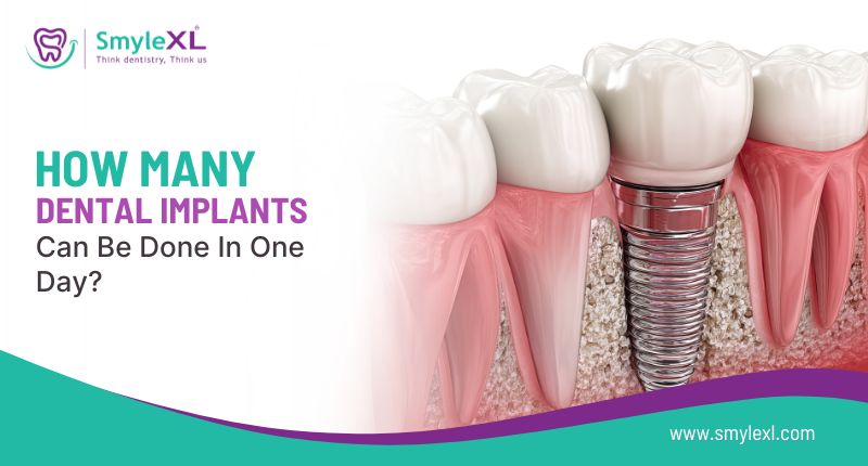 How Many Dental Implants Can Be Done in One Day?