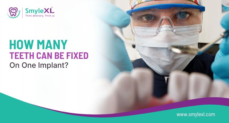 How Many Teeth Can Be Fixed on One Implant?