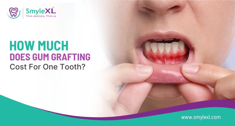 How Much Does Gum Grafting Cost for One Tooth?