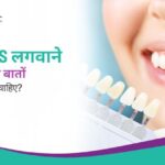 Veneers लगवाने से पहले किन बातों का ध्यान रखना चाहिए?