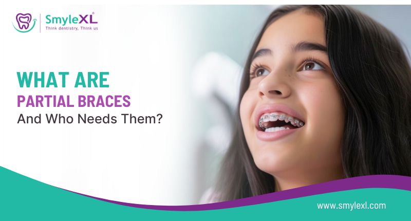 What Are Partial Braces and Who Needs Them?