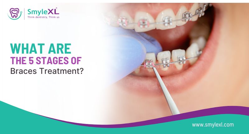 What Are the 5 Stages of Braces Treatment?