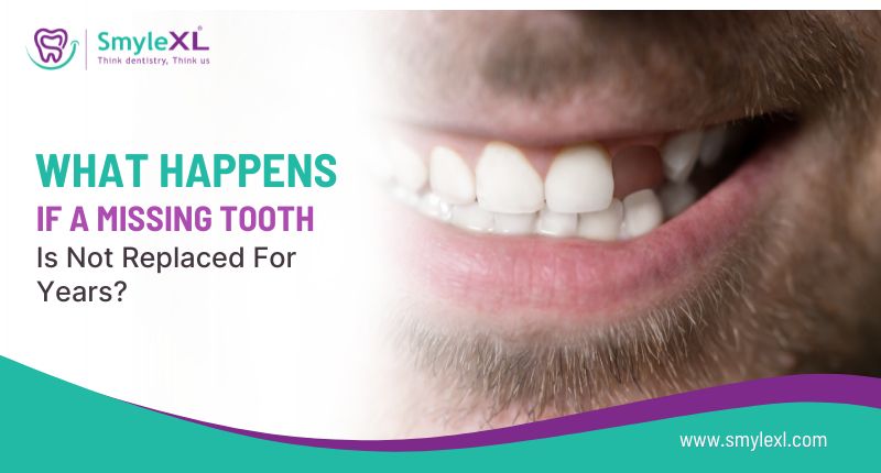 What Happens If a Missing Tooth Is Not Replaced for Years?