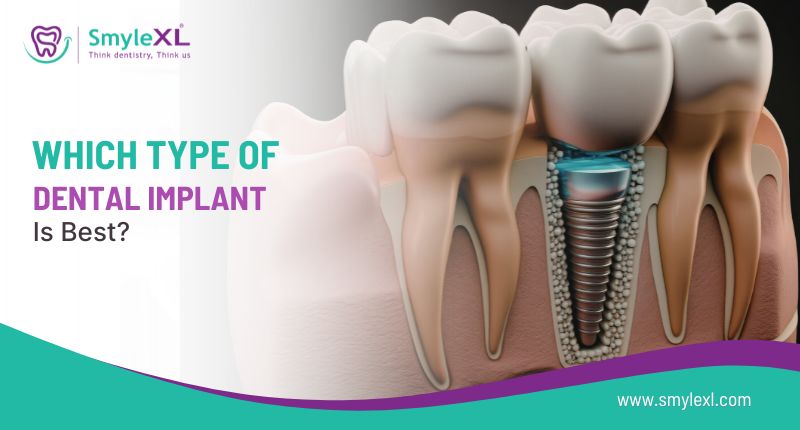 Which Type of Dental Implant Is Best?