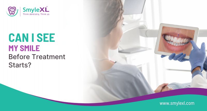 Can I See My Smile Before Treatment Starts?