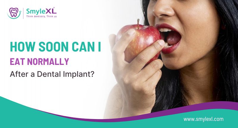 How Soon Can I Eat Normally After a Dental Implant?