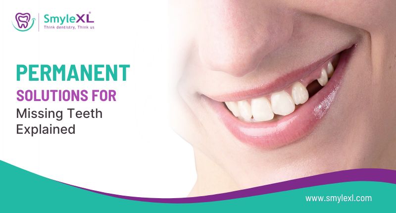 Permanent Solutions for Missing Teeth Explained