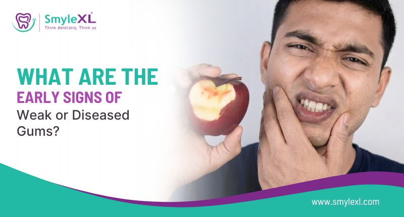 What Are the Early Signs of Weak or Diseased Gums?