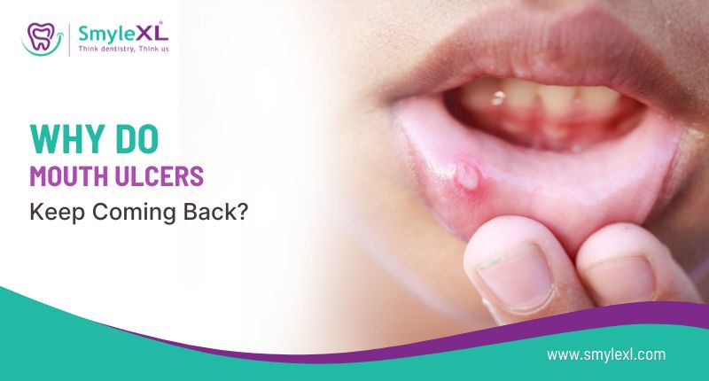 Why Do Mouth Ulcers Keep Coming Back?