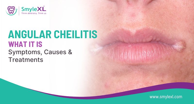 Angular Cheilitis: What It Is, Symptoms, Causes, and Treatment