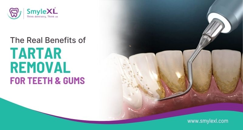 The Real Benefits of Tartar Removal for Your Teeth and Gums