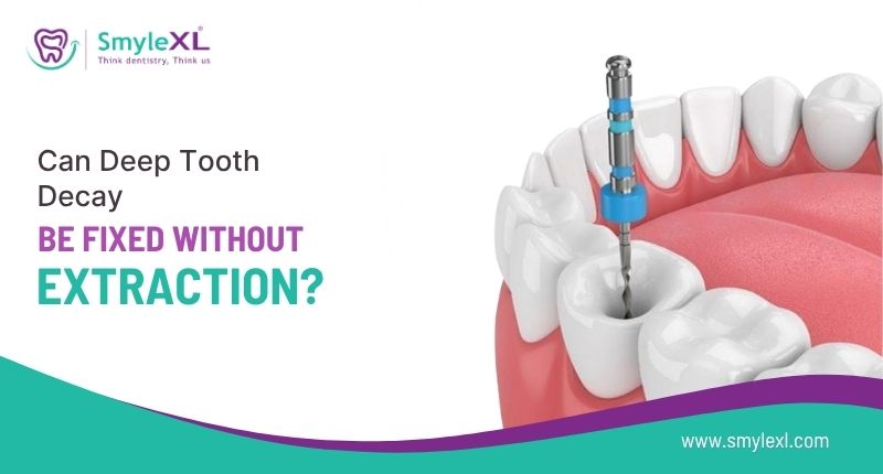 Can Deep Tooth Decay Be Fixed Without Extraction?