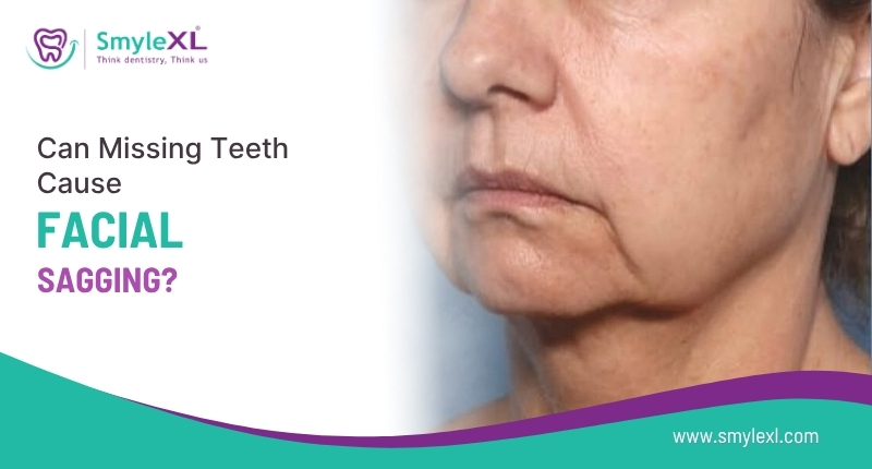 Can Missing Teeth Cause Facial Sagging?