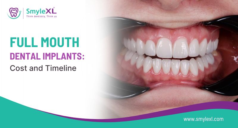 Full Mouth Dental Implants: Cost and Timeline