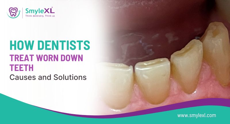 How Dentists Treat Worn-Down Teeth: Causes and Solutions
