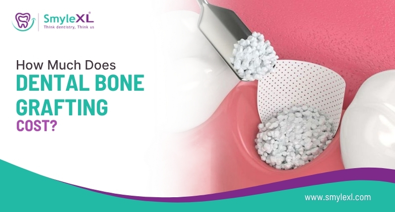 How Much Does Dental Bone Grafting Cost?