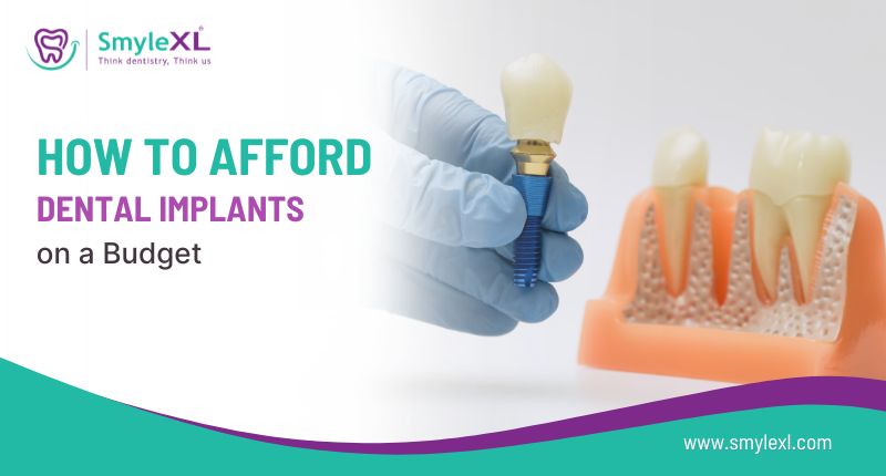 How to Afford Dental Implants on a Budget?