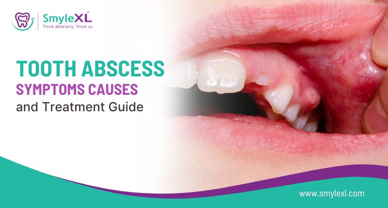 Tooth Abscess Symptoms, Causes, and Treatment Guide