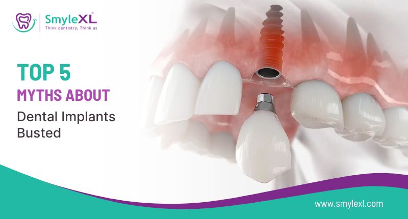Top 5 Myths About Dental Implant Treatment Busted