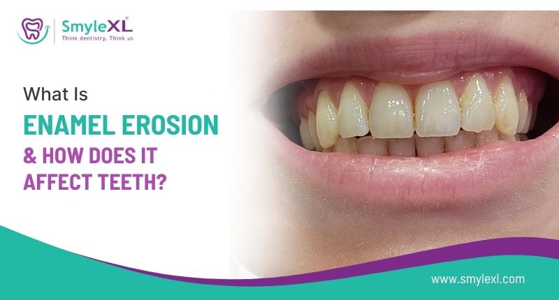 What Is Enamel Erosion and How Does It Affect Your Teeth?