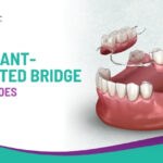What Is an Implant-Supported Bridge and How Does It Work?
