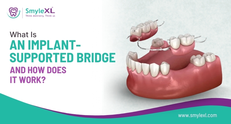 What Is an Implant-Supported Bridge and How Does It Work?