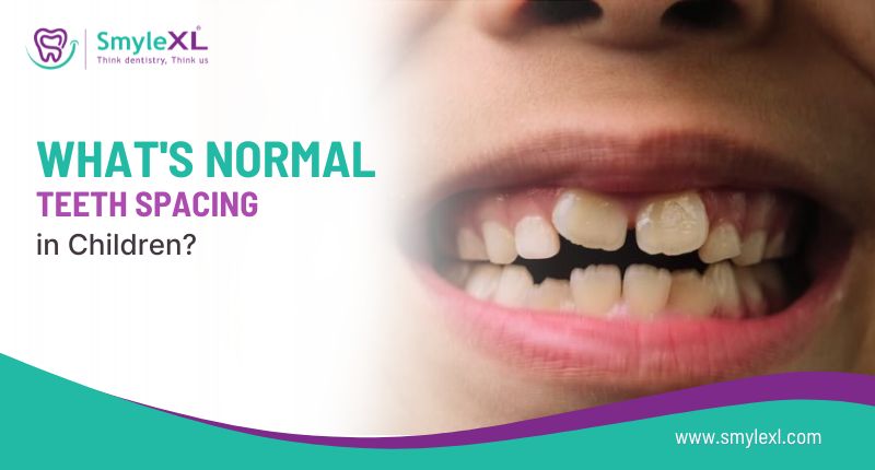 What’s Normal Teeth Spacing in Children?