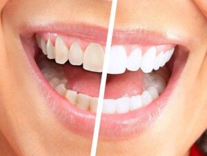 laser whitening