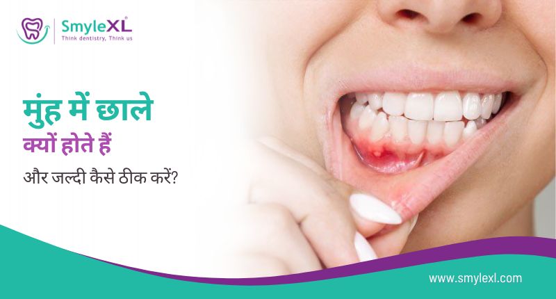मुंह में छाले क्यों होते हैं और जल्दी कैसे ठीक करें?